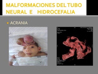  ACRANIAACRANIA
 