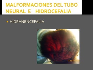  HIDRANENCEFALIAHIDRANENCEFALIA
 