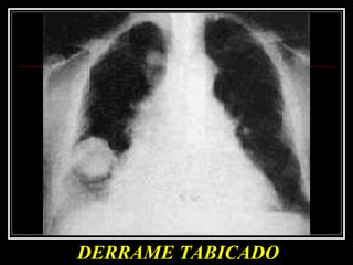 DERRAME TABICADO 