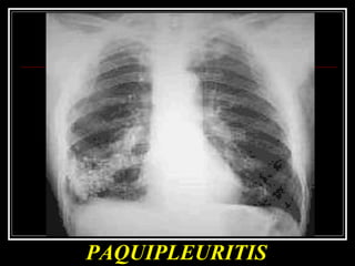 PAQUIPLEURITIS 