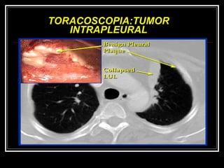 TORACOSCOPIA:TUMOR INTRAPLEURAL 