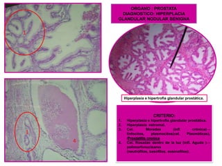 ORGANO : PROSTATA
DIAGNOSTICO: HIPERPLACIA
GLANDULAR NODULAR BENIGNA

1

Hiperplasia e hipertrofia glandular prostática.

CRITERIO:
1.
2.
3.

1
4

4.

Hiperplasia e hipertrofia glandular prostática.
Hiperplasia estromal.
Cel.
Moradas
(infl
crónica)→
linfocitos,
plasmocitos(cel.
Plasmáticas).
∕Prostatitis cronica
Cel. Rosadas dentro de la luz (infl. Aguda )→
polimorfonucleares
(neutrófilos, basófilos, eosinofilos).

 