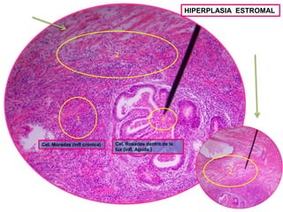 HIPERPLASIA ESTROMAL

2

3

Cel. Moradas (infl crónica)

4

Cel. Rosadas dentro de la
luz (infl. Aguda )

2

 