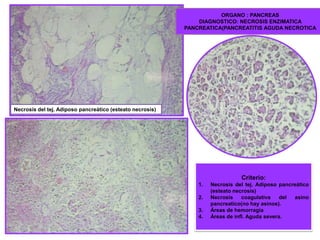 ORGANO : PANCREAS
DIAGNOSTICO: NECROSIS ENZIMATICA
PANCREATICA(PANCREATITIS AGUDA NECROTICA
Necrosis del tej. Adiposo pancreático (esteato necrosis)
Criterio:
1.
2.
3.
4.
Necrosis del tej. Adiposo pancreático
(esteato necrosis)
Necrosis
coagulativa
del
asino
pancreatico(no hay asinos).
Áreas de hemorragia
Áreas de infl. Aguda severa.