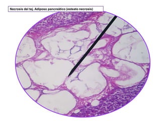 Necrosis del tej. Adiposo pancreático (esteato necrosis)

 