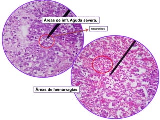 Áreas de infl. Aguda severa.
neutrofilos

Áreas de hemorragias

 