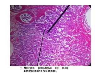 1. Necrosis coagulativa del
pancreatico(no hay asinos).

asino

 