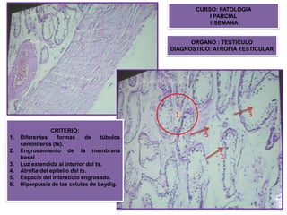 CURSO: PATOLOGIA
I PARCIAL
1 SEMANA

ORGANO : TESTICULO
DIAGNOSTICO: ATROFIA TESTICULAR

1
1.
2.
3.
4.
5.
6.

CRITERIO:
Diferentes
formas
de
túbulos
seminíferos (ts).
Engrosamiento de la membrana
basal.
Luz extendida al interior del ts.
Atrofia del epitelio del ts.
Espacio del intersticio engrosado.
Hiperplasia de las células de Leydig.

3
5

 