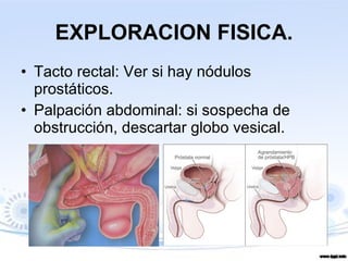 EXPLORACION FISICA. Tacto rectal: Ver si hay nódulos prostáticos. Palpación abdominal: si sospecha de obstrucción, descartar globo vesical. 
