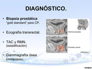 DIAGNÓSTICO. Biopsia prostática :  “gold standard” para CP . Ecografía transrectal. TAC y RMN.  (estadificación) Gammagrafía ósea ( metástasis). 