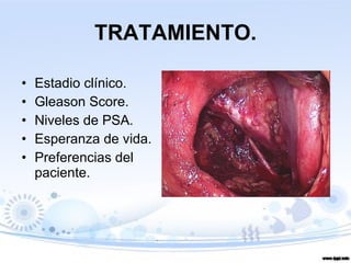 TRATAMIENTO. Estadio clínico. Gleason Score. Niveles de PSA. Esperanza de vida. Preferencias del paciente. 
