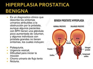  Es un diagnostico clínico que
describe los síntomas
urinarios atribuibles a la
obstrucción por la próstata,
aunque algunos pacientes
con BPH tienen una glándula
poco aumentada de volumen,
y algunos individuos con
próstata grandes no tienen
síntomas, los cuales incluyen:
 Polaquiuria,
 Urgencia vesical,
 Dificultad para iniciar la
micción
 Chorro urinario de flujo lento
 Nicturia.
 