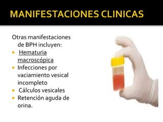 Otras manifestaciones
de BPH incluyen:
 Hematuria
macroscópica
 Infecciones por
vaciamiento vesical
incompleto
 Cálculos vesicales
 Retención aguda de
orina.
 