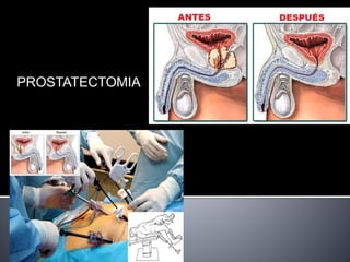 PROSTATECTOMIA
 