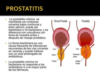  La prostatitis crónica se
manifiesta con síntomas
urinarios bajos continuos y
dolor pélvico; puede ser
bacteriana o no bacteriana, y se
diferencia con urocultivos con
toma de muestra antes y
después de masaje prostático.
 La forma bacteriana es una
causa frecuente de infecciones
recurrentes de las vías urinarias
en varones y puede tratarse
con un ciclo prolongado de
antibióticos.
 La prostatitis crónica no
bacteriana no responde a los
antibióticos ni a la mayor parte
de los fármacos.
 