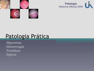 Patologia Prática Hiperemia Hemorragia Trombose Infarto Patologia Medicina Alfenas 2008 