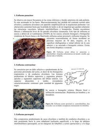 1. Enfisema panacinar

Se observa con mayor frecuencia en las zonas inferiores y bordes anteriores de cada pulmón.
Es más acentuado en las bases. Macroscópicamente hay pérdida del contraste normal entre
alvéolos y conductos alveolares con aparente simplificación de la arquitectura pulmonar. Las
alteraciones aumentan hasta que la pérdida de tejido es de tal magnitud que quedan solamente
las estructuras vasculares, tabiques interlobulillares y bronquíolos. Pueden encontrarse
fibrosis e inflamación leves de las paredes alveolares remanentes. Este tipo de enfisema se
asocia a déficit de α-1-antitripsina (70-80% de los casos), oclusión bronquial y bronquiolar
(síndrome de Swyer-James o de MacLeod), enfisema acinar proximal y enfisema irregular. Se
                                         encuentra ocasionalmente en forma incidental en
                                         personas mayores de 70 años, mujeres, en la
                                         superficie diafragmática y mitad inferior de la cara
                                         anterior y no asociado a bronquitis crónica. Existe
                                         una forma idiopática o esencial.

                                         Figura 15: Enfisema acinar difuso (e. panacinar, e.
                                         panlobulillar). Ampollas enfisematosas de tamaño variable, que
                                         afectan todo el lobulillo.




2. Enfisema centroacinar

Se caracteriza por un daño selectivo o predominante de las
porciones proximales del acino, es decir de los bronquíolos
respiratorios y de conductos alveolares. Las lesiones
predominan en lóbulos superiores y segmentos póstero-
apicales y segmentos superiores del lóbulo inferior. Los
espacios      adyacentes     y     tejidos     circundantes
característicamente contienen gran cantidad de pigmento
negro.

                                        Se asocia a bronquitis crónica, fibrosis focal e
                                        infiltración mononuclear. Predomina en hombres y en
                                        fumadores.



                                        Figura 16: Enfisema acinar proximal (e. centrolobulillar), fase
                                        avanzada. Las cavidades reemplazan extensamente los lobulillos.




3. Enfisema paraseptal

Hay compromiso predominante de sacos alveolares y también de conductos alveolares y es
más prominente hacia la zona subpleural (enfisema superficial), a lo largo de tabiques
interlobulillares (paraseptal), en los márgenes de lobulillos y acinos (periacinar) y a lo largo
 