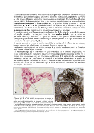 La característica más distintiva de estas células es la presencia de cuerpos laminares unidos a
la membrana que contienen agente tensoactivo pulmonar (surfactante), el producto secretorio
de estas células. El agente tensoactivo pulmonar, que se sintetiza en el Retículo Endoplásmico
Rugoso (RER) de los neumocitos tipo II, se compone principalmente de dos fosfolípidos,
dipalmitoilfosfatidilcolina y fosfatidilglicerol, y 4 proteínas únicas, proteínas del agente
tensoactivo A, B, C y D. El agente tensoactivo se modifica en el aparato de Golgi y a
continuación se libera de la red de Golgi trans a vesículas secretorias, conocidas como
cuerpos compuestos, los precursores inmediatos de los cuerpos laminares.
El agente tensoactivo se libera por exocitosis hacia la luz de los alveolos en donde forma una
red amplia parecida a un enrejado conocida como mielina tubular, que se separa en
porciones lipídica y proteínica. El lípido se inserta en una película monomolecular de
fosfolípidos que forma un interfaz con el aire y la proteína penetra en la capa acuosa entre los
neumocitos y la película fosfolipídica.
El agente tensoactivo reduce la tensión superficial e impide así el colapso de los alveolos
durante la espiración y facilitando la expansión durante la inspiración.
Lo elaboran continuamente los neumocitos tipo II y, según pruebas reciente, lo fagocitan
estos últimos y macrófagos alveolares.
Los neumocitos tipo 2 y el surfactante son ya detectables a las 28 semanas de gestación, por
lo que los recién nacidos prematuros mayores de esta edad pueden teóricamente respirar por sí
mismos pero sin embargo entre las 28 semanas y el término de la gestación, las cantidades de
surfactante pueden ser insuficientes o consumirse demasiado rápidamente, y puede ser
necesario un soporte respiratorio artificial. La insuficiencia de surfactante da lugar al colapso
alveolar, con lesión de los neumocitos tipo I en el denominado “Síndrome de dificultad
respiratoria del lactante”.




Fig. 8 Neumocito tipo 2 y surfactante.
® Tinción H&E de un corte delgado de resina acrílica que muestra la
confluencia de las paredes alveolares de tres alveolos adyacentes. En los
ángulos hay células redondeadas con un citoplasma vacuolado; éstas son
neumocitos tipo 2 (T2). También se ve el núcleo de un neumocito tipo 1 (T1).
® Microfotografía electrónica que muestra un neumocito tipo 2 activo. La célula es redonda y posee una cara luminal convexa que está
cubierta de microvellosidades. Las organelas intracitoplasmáticas más obvias son grandes cuerpos esféricos (B) rodeados de membrana que
contienen material laminar lipoproteico, que representa el surfactante. También se suelen ver descargando su contenido sobre la superficie
luminal (flechas).
© Microfotografía electrónica de barrido de dos neumocitos tipo 2. Obsérvense las microvellosidades (M) y las pequeñas cantidades de
material granuloso (flechas) que es surfactante recientemente arrojado.
 