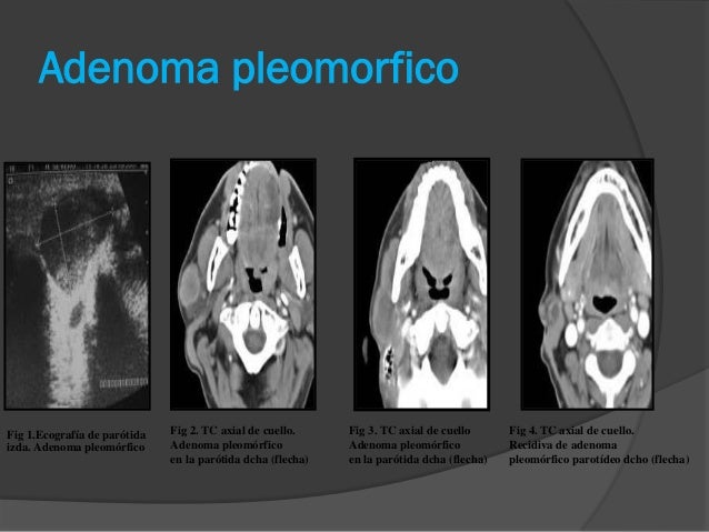 Patologia Quirurgica de Parotida