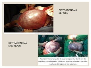 CISTOADENOMA
SEROSO
CISTOADENOMA
MUCINOSO
 