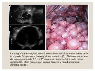 La ecografía transvaginal mostró formaciones quísticas en las áreas de la
trompa de Falopio derecha (A) y el fondo uterino (B). El diámetro máximo
de los quistes fue de 7,5 cm. Presentación laparoscópica de la masa
quística (C); útero (frente) con trompa derecha y pared abdominal
derecha (fondo).
 