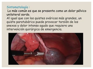 Sintomatología :
Lo más común es que se presente como un dolor pélvico
unilateral sordo.
Al igual que con los quistes ováricos más grandes, un
quiste paratubárico puede provocar torsión de los
anexos y dolor intenso agudo que requiere una
intervención quirúrgica de emergencia.
 