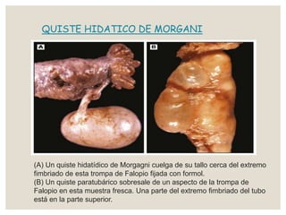 QUISTE HIDATICO DE MORGANI
(A) Un quiste hidatídico de Morgagni cuelga de su tallo cerca del extremo
fimbriado de esta trompa de Falopio fijada con formol.
(B) Un quiste paratubárico sobresale de un aspecto de la trompa de
Falopio en esta muestra fresca. Una parte del extremo fimbriado del tubo
está en la parte superior.
 