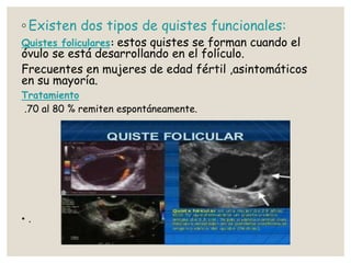 ◦ Existen dos tipos de quistes funcionales:
Quistes foliculares: estos quistes se forman cuando el
óvulo se está desarrollando en el folículo.
Frecuentes en mujeres de edad fértil ,asintomáticos
en su mayoría.
Tratamiento
.70 al 80 % remiten espontáneamente.
• .
 