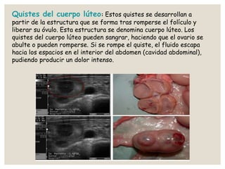 Quistes del cuerpo lúteo: Estos quistes se desarrollan a
partir de la estructura que se forma tras romperse el folículo y
liberar su óvulo. Esta estructura se denomina cuerpo lúteo. Los
quistes del cuerpo lúteo pueden sangrar, haciendo que el ovario se
abulte o pueden romperse. Si se rompe el quiste, el fluido escapa
hacia los espacios en el interior del abdomen (cavidad abdominal),
pudiendo producir un dolor intenso.
 