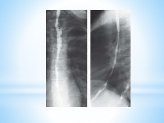 Patologia radiologica del esofago | PPTX