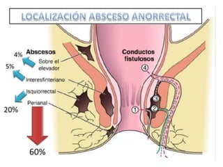 anatomia recto anal y absceso perianal