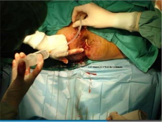 anatomia recto anal y absceso perianal