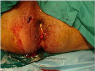 anatomia recto anal y absceso perianal