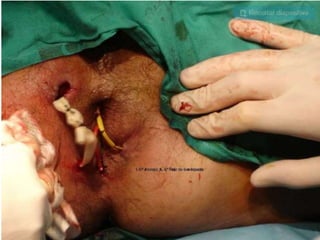 anatomia recto anal y absceso perianal