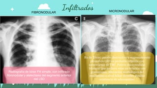 Patologia respiratoria-Tuberculosis .pptx