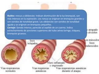 Ruidos: roncus y sibilancias: Indican disminución de la luz bronquial, son
más intensos en la espiración. Los roncus se originan en bronquios grandes y
son sonidos de tonalidad grave. Las sibilancias son sonidos de tonalidad
aguda y se originan en bronquios pequeños.
Cornaje: Sonido intenso, parecido al soplido de un cuerno. Indica
estrechamiento de porciones superiores del tubo aéreo:laringe, tráquea,
bronquios gruesos.
 