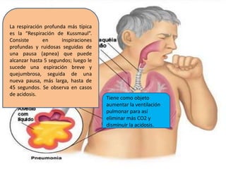 La respiración profunda más típica
es la “Respiración de Kussmaul”.
Consiste en inspiraciones
profundas y ruidosas seguidas de
una pausa (apnea) que puede
alcanzar hasta 5 segundos; luego le
sucede una espiración breve y
quejumbrosa, seguida de una
nueva pausa, más larga, hasta de
45 segundos. Se observa en casos
de acidosis.
Tiene como objeto
aumentar la ventilación
pulmonar para así
eliminar más CO2 y
disminuir la acidosis.
 