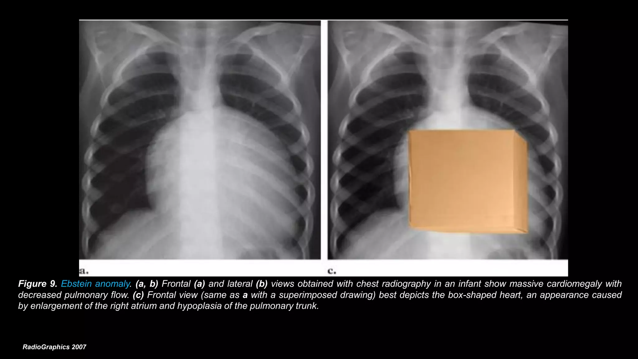 Patologia rx tc rmn cardiopatias congenitas 2018 | PDF
