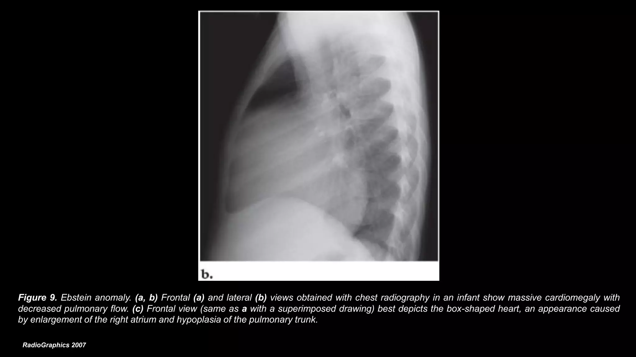 Patologia rx tc rmn cardiopatias congenitas 2018 | PDF