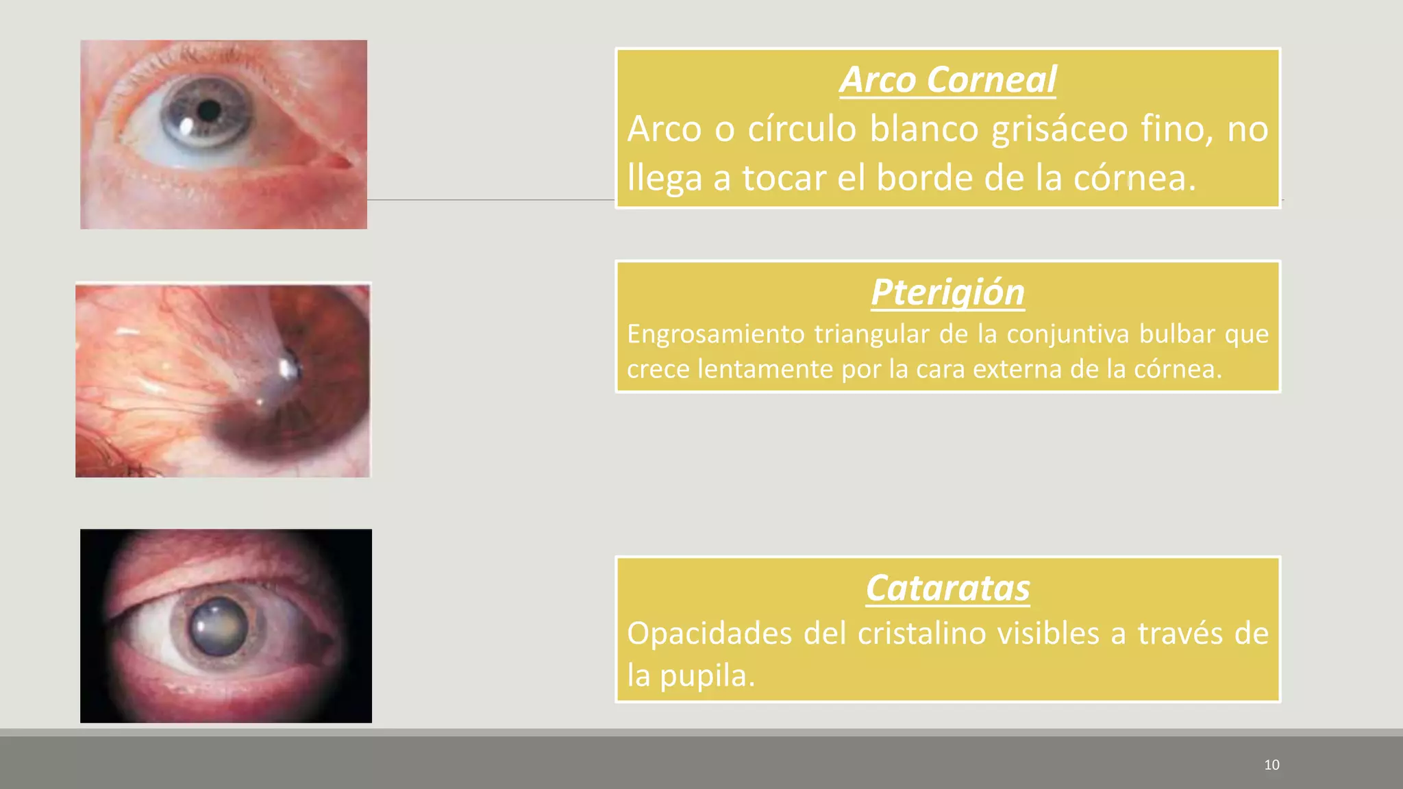Arco Corneal
Arco o círculo blanco grisáceo fino, no
llega a tocar el borde de la córnea.
Pterigión
Engrosamiento triangular de la conjuntiva bulbar que
crece lentamente por la cara externa de la córnea.
Cataratas
Opacidades del cristalino visibles a través de
la pupila.
10
 