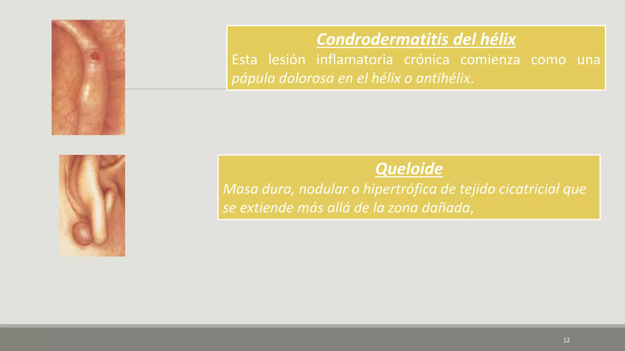 12
Condrodermatitis del hélix
Esta lesión inflamatoria crónica comienza como una
pápula dolorosa en el hélix o antihélix.
Queloide
Masa dura, nodular o hipertrófica de tejido cicatricial que
se extiende más allá de la zona dañada,
 