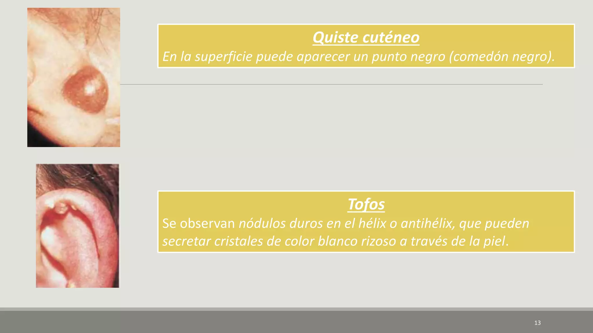13
Quiste cuténeo
En la superficie puede aparecer un punto negro (comedón negro).
Tofos
Se observan nódulos duros en el hélix o antihélix, que pueden
secretar cristales de color blanco rizoso a través de la piel.
 
