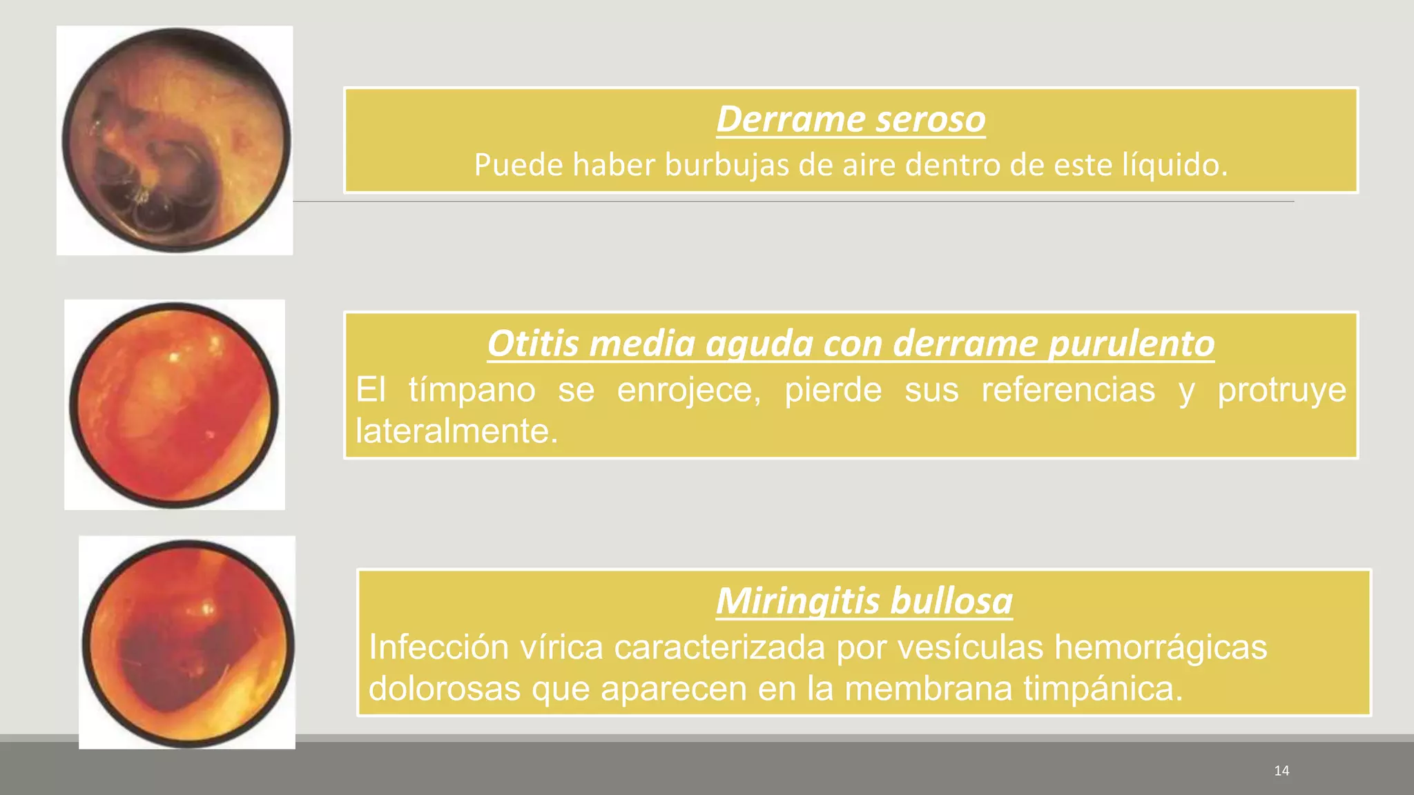 14
Derrame seroso
Puede haber burbujas de aire dentro de este líquido.
Otitis media aguda con derrame purulento
El tímpano se enrojece, pierde sus referencias y protruye
lateralmente.
Miringitis bullosa
Infección vírica caracterizada por vesículas hemorrágicas
dolorosas que aparecen en la membrana timpánica.
 
