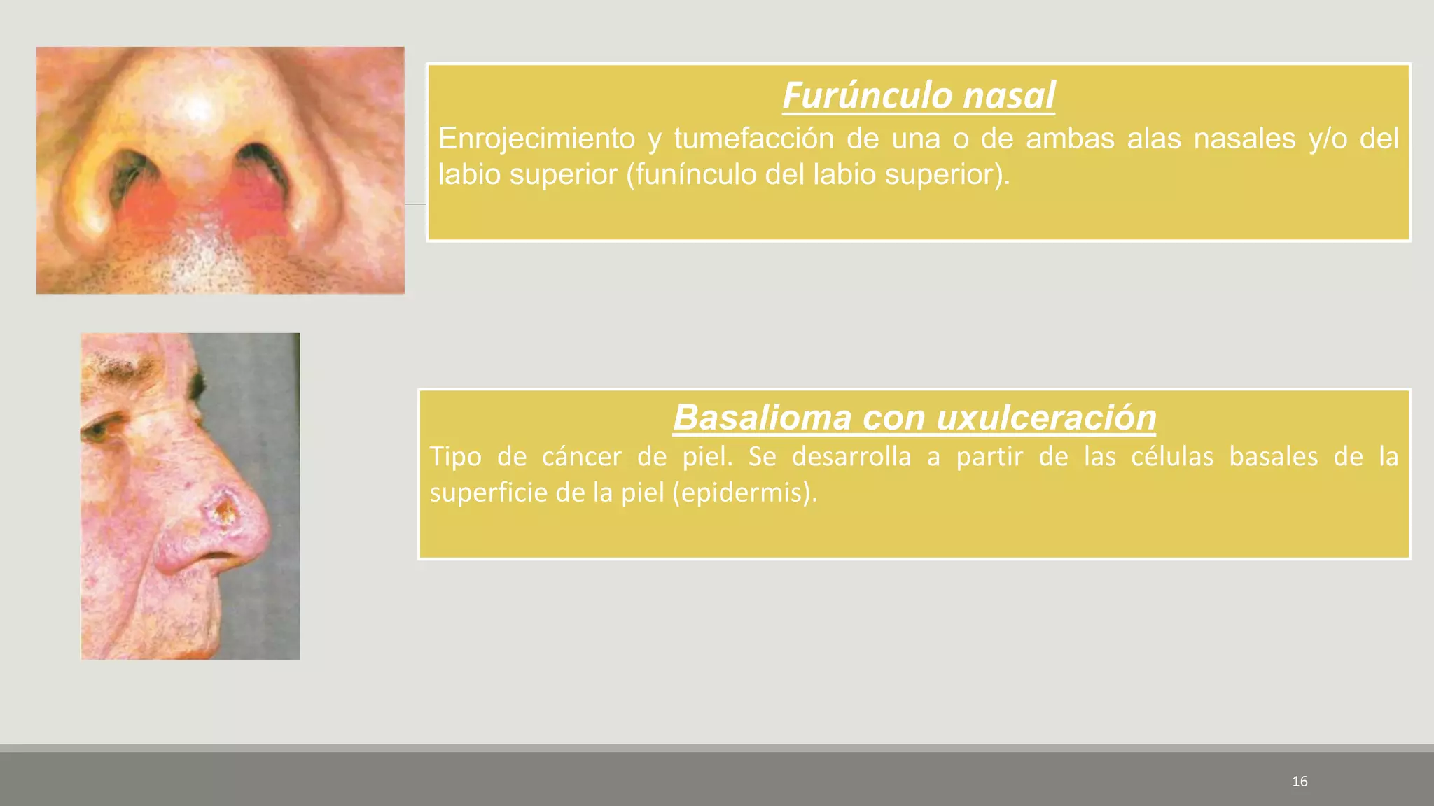 16
Furúnculo nasal
Enrojecimiento y tumefacción de una o de ambas alas nasales y/o del
labio superior (funínculo del labio superior).
Basalioma con uxulceración
Tipo de cáncer de piel. Se desarrolla a partir de las células basales de la
superficie de la piel (epidermis).
 