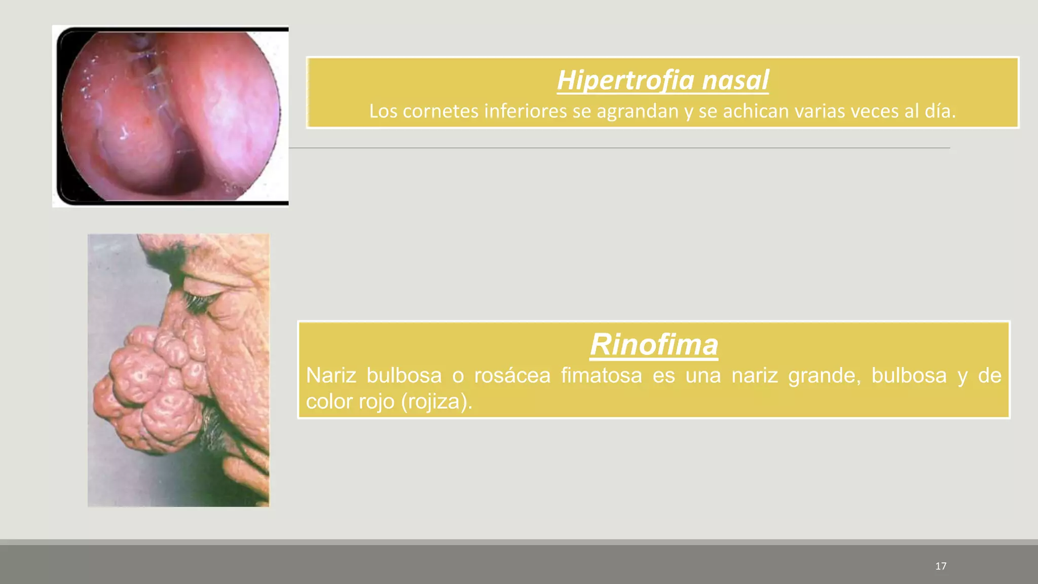17
Hipertrofia nasal
Los cornetes inferiores se agrandan y se achican varias veces al día.
Rinofima
Nariz bulbosa o rosácea fimatosa es una nariz grande, bulbosa y de
color rojo (rojiza).
 