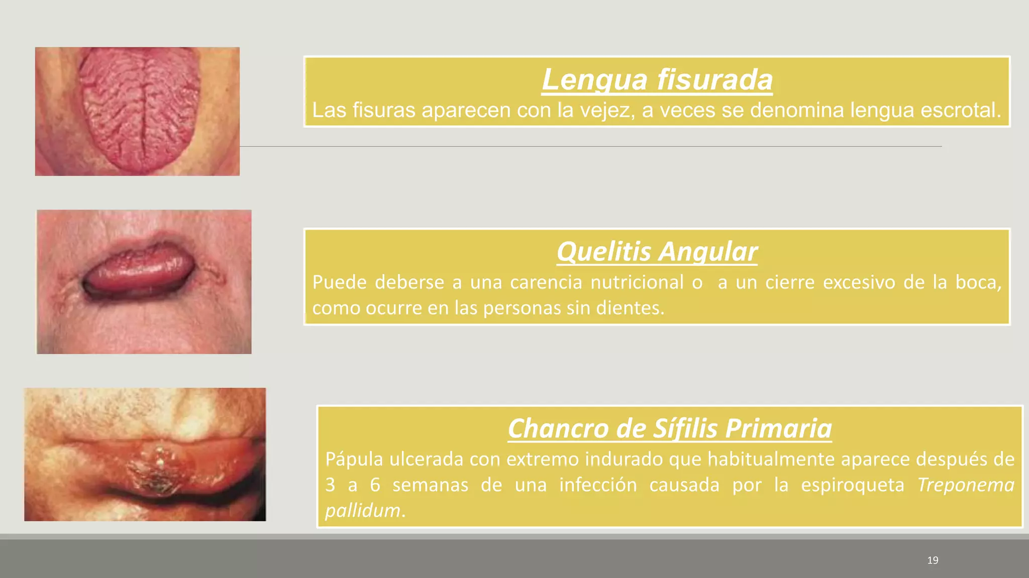 19
Lengua fisurada
Las fisuras aparecen con la vejez, a veces se denomina lengua escrotal.
Quelitis Angular
Puede deberse a una carencia nutricional o a un cierre excesivo de la boca,
como ocurre en las personas sin dientes.
Chancro de Sífilis Primaria
Pápula ulcerada con extremo indurado que habitualmente aparece después de
3 a 6 semanas de una infección causada por la espiroqueta Treponema
pallidum.
 