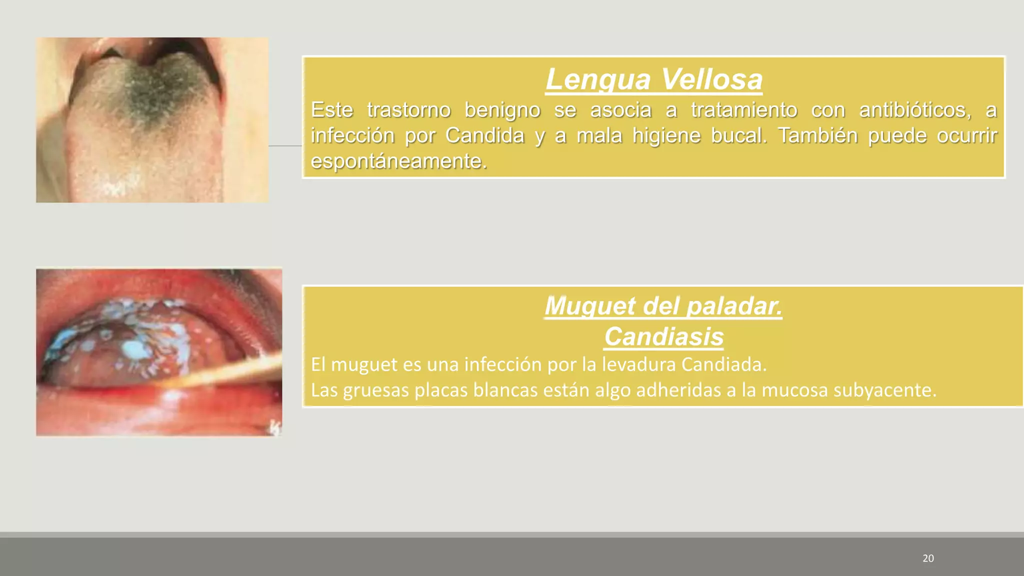 20
Lengua Vellosa
Este trastorno benigno se asocia a tratamiento con antibióticos, a
infección por Candida y a mala higiene bucal. También puede ocurrir
espontáneamente.
Muguet del paladar.
Candiasis
El muguet es una infección por la levadura Candiada.
Las gruesas placas blancas están algo adheridas a la mucosa subyacente.
 