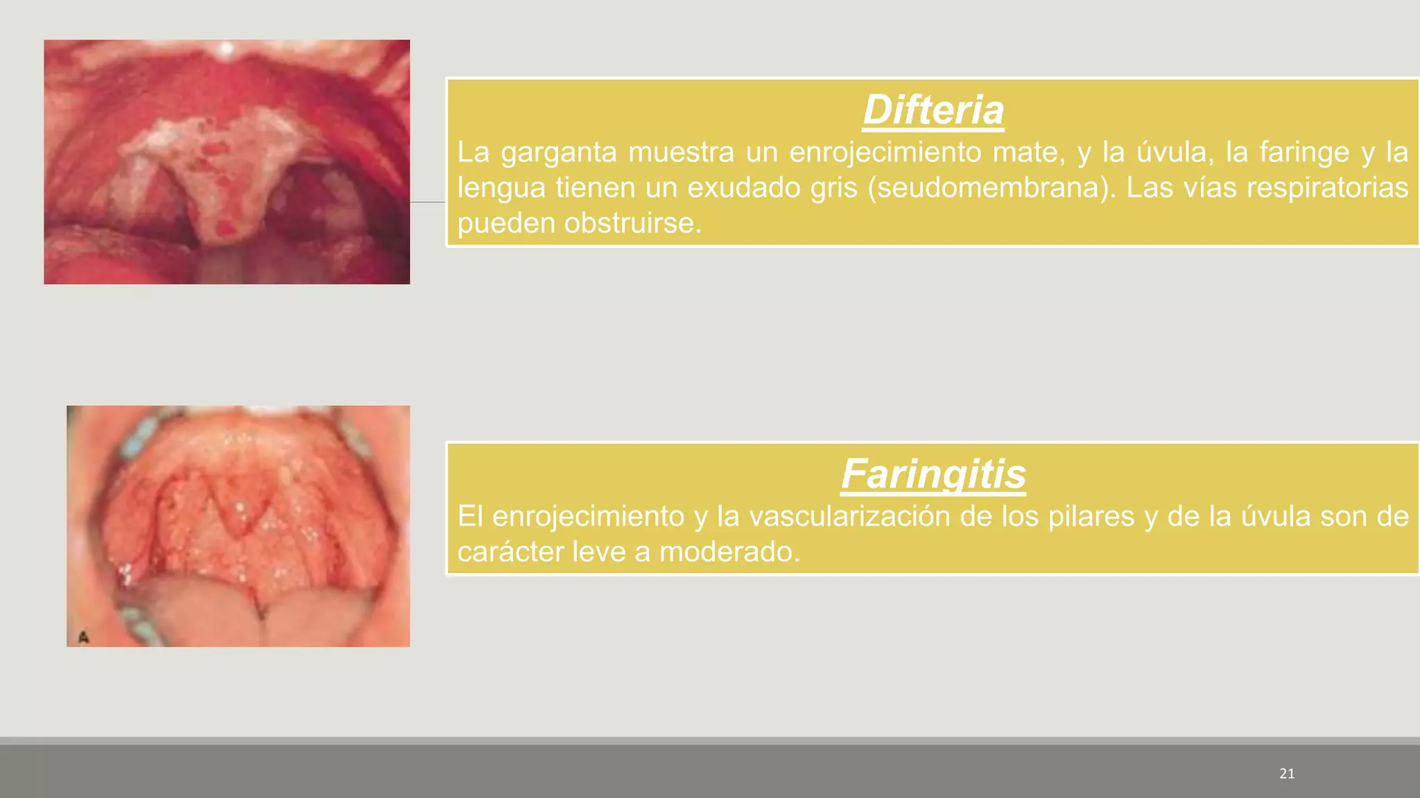 21
Difteria
La garganta muestra un enrojecimiento mate, y la úvula, la faringe y la
lengua tienen un exudado gris (seudomembrana). Las vías respiratorias
pueden obstruirse.
Faringitis
El enrojecimiento y la vascularización de los pilares y de la úvula son de
carácter leve a moderado.
 