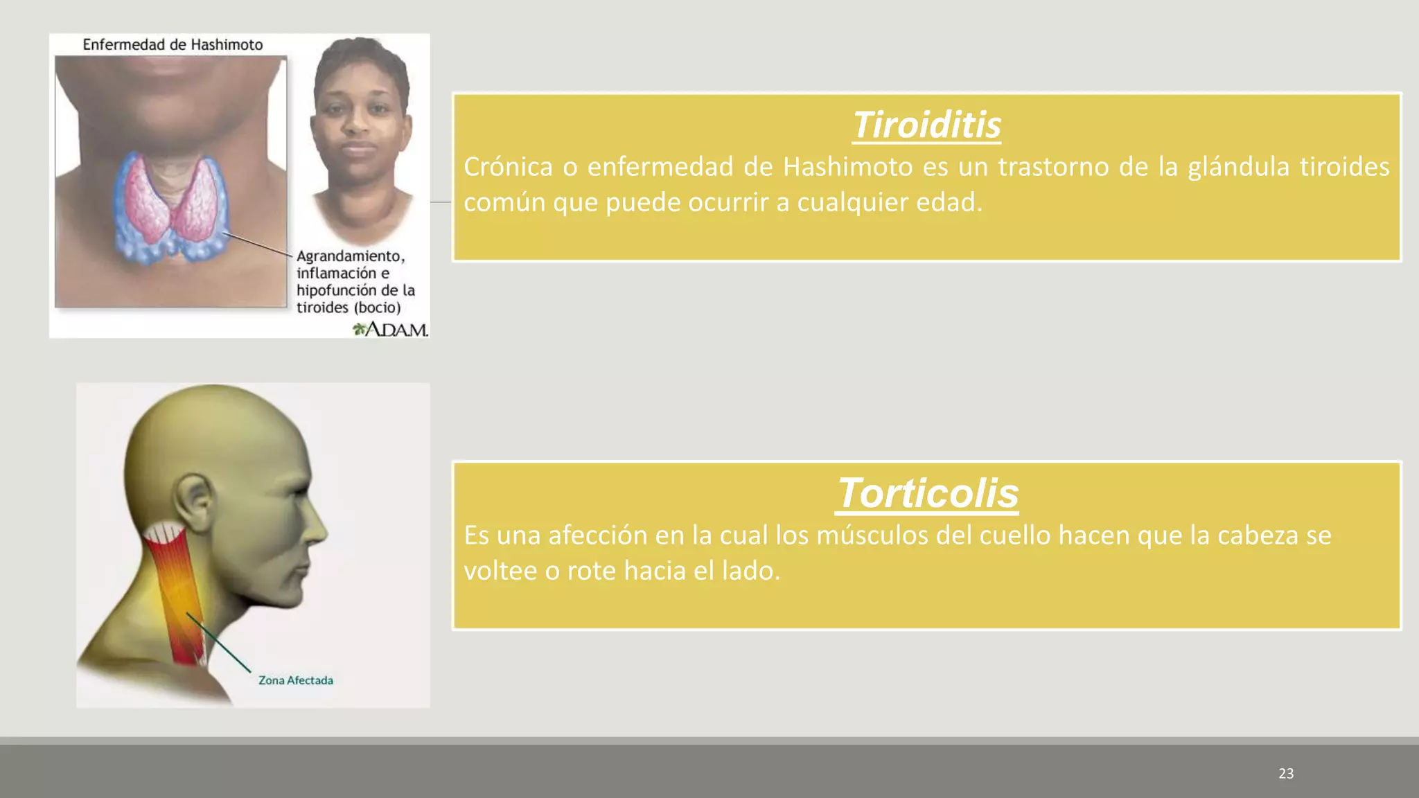 23
Tiroiditis
Crónica o enfermedad de Hashimoto es un trastorno de la glándula tiroides
común que puede ocurrir a cualquier edad.
Torticolis
Es una afección en la cual los músculos del cuello hacen que la cabeza se
voltee o rote hacia el lado.
 