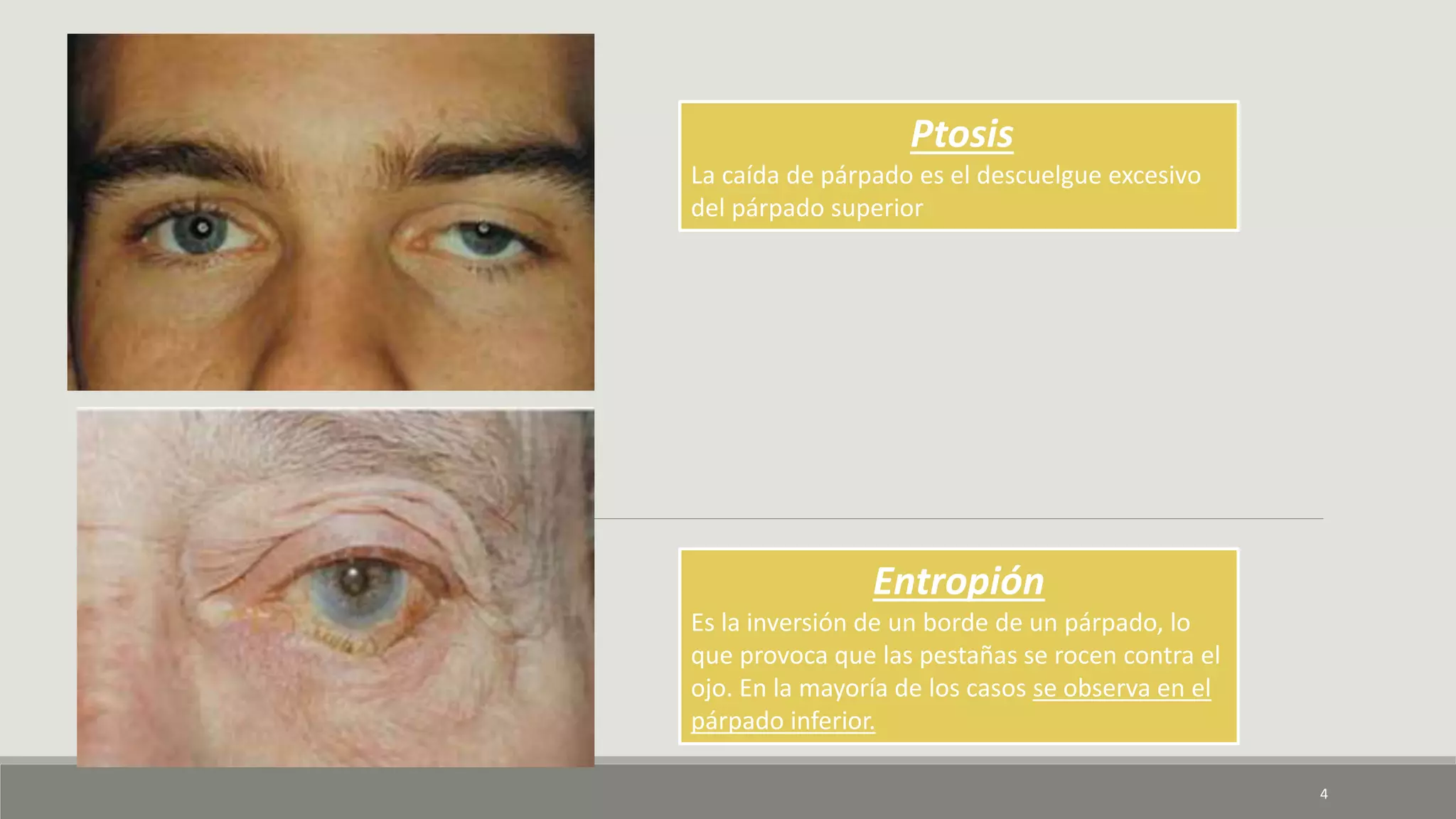 Ptosis
La caída de párpado es el descuelgue excesivo
del párpado superior
Entropión
Es la inversión de un borde de un párpado, lo
que provoca que las pestañas se rocen contra el
ojo. En la mayoría de los casos se observa en el
párpado inferior.
4
 
